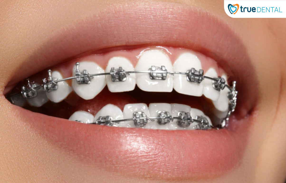 5 CHIA SẺ TỪ BÁC SĨ TRUE DENTAL VỀ NIỀNG RĂNG BẠN NÊN BIẾT 1 NIỀNG RĂNG BẠN NÊN BIẾT