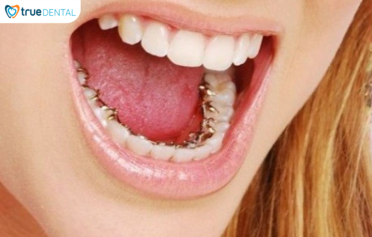 5 CHIA SẺ TỪ BÁC SĨ TRUE DENTAL VỀ NIỀNG RĂNG BẠN NÊN BIẾT 10 Niềng răng mắc cài mặt lưỡi được gắn vào mặt trong của răng giúp tăng hiệu quả thẩm mỹ