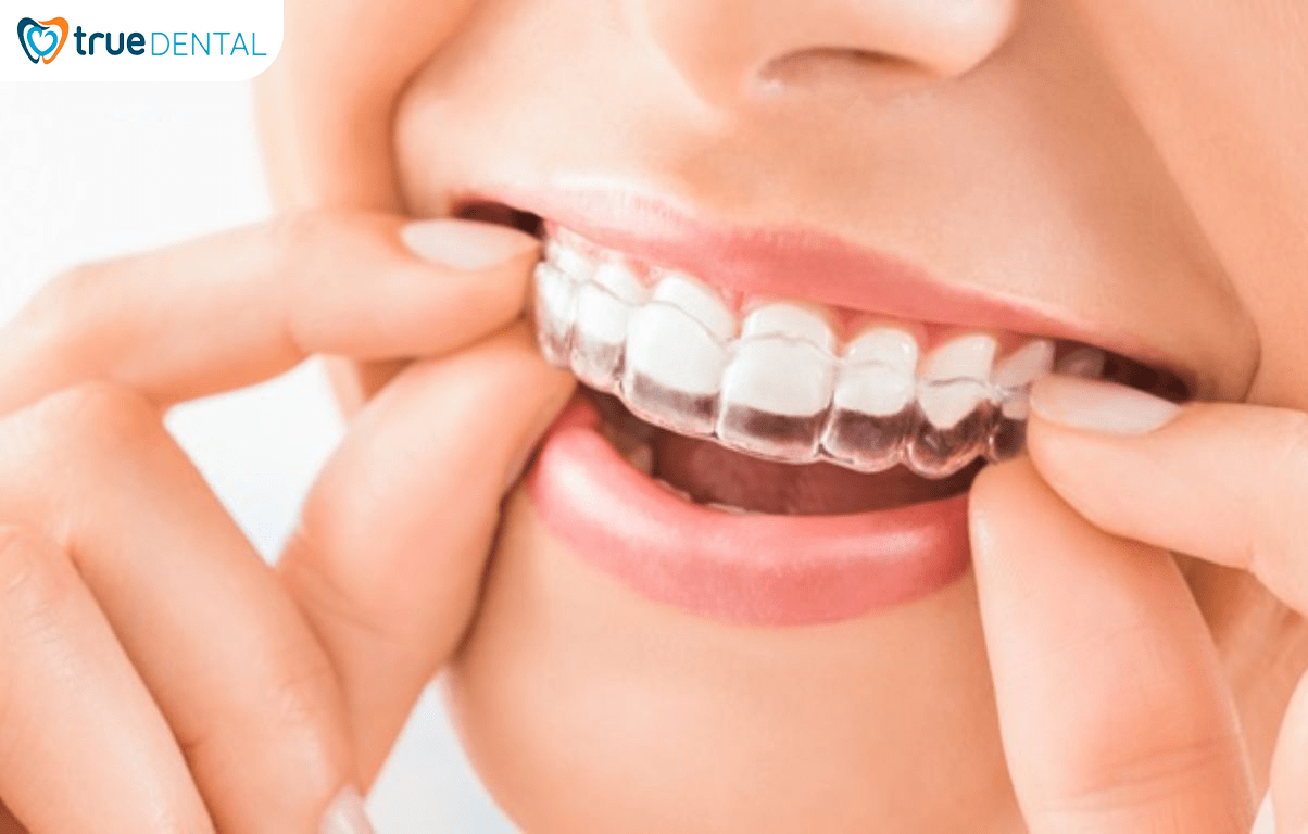 5 CHIA SẺ TỪ BÁC SĨ TRUE DENTAL VỀ NIỀNG RĂNG BẠN NÊN BIẾT 11 Niềng răng trong suốt là kỹ thuật niềng răng hiện đại nhất hiện nay