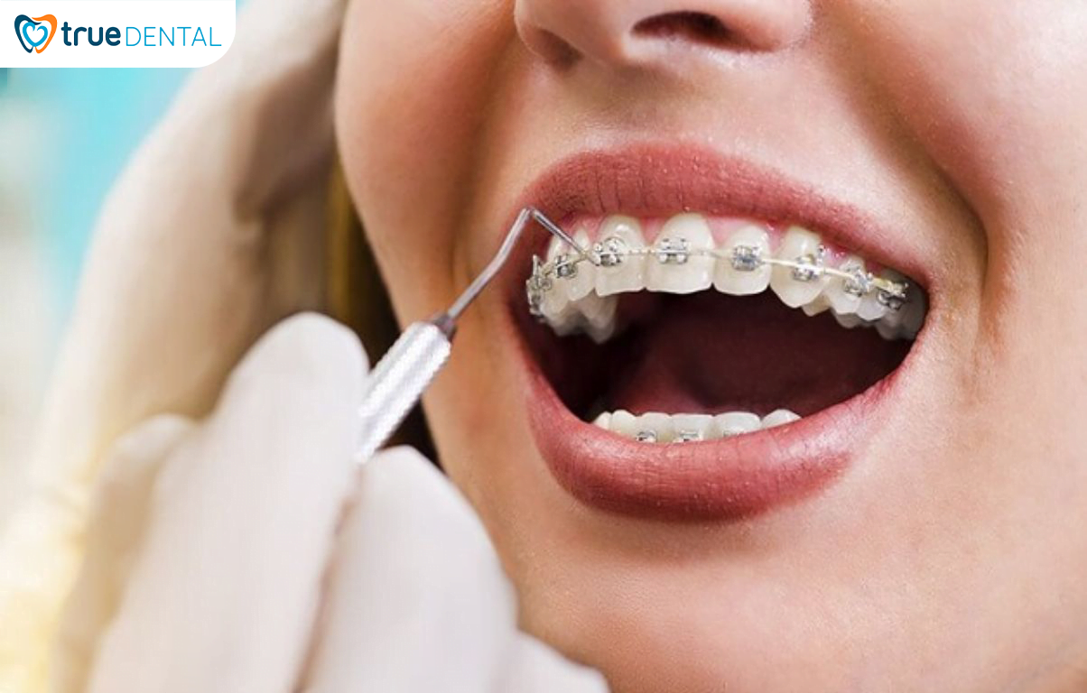 5 CHIA SẺ TỪ BÁC SĨ TRUE DENTAL VỀ NIỀNG RĂNG BẠN NÊN BIẾT 13 Bạn sẽ được niềng răng sau khi đã điều trị tổng quát