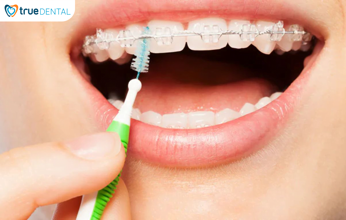 5 CHIA SẺ TỪ BÁC SĨ TRUE DENTAL VỀ NIỀNG RĂNG BẠN NÊN BIẾT 15 Sử dụng các dụng cụ hỗ trợ làm sạch răng miệng để đạt hiệu quả chăm sóc tốt nhất