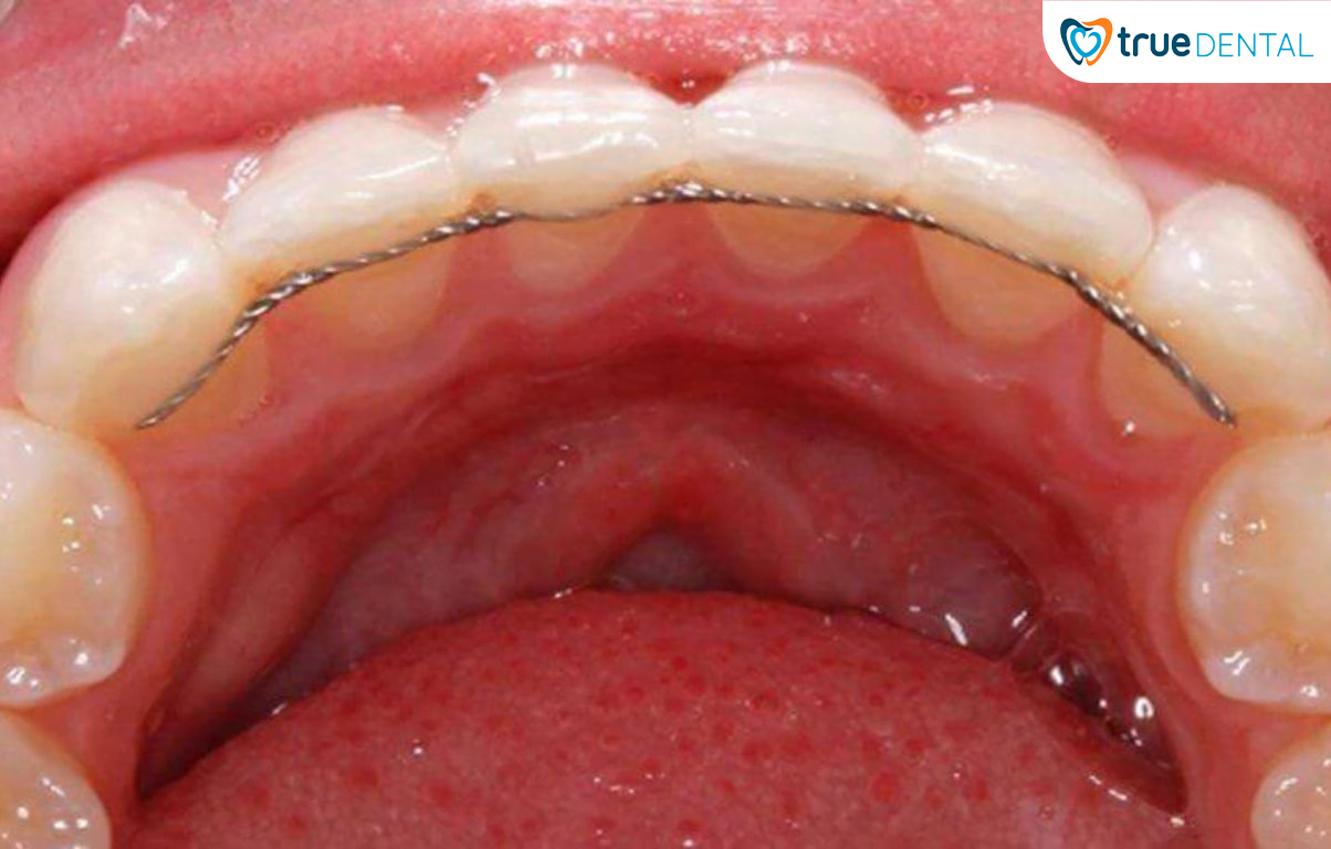 VÌ SAO PHẢI ĐEO HÀM DUY TRÌ SAU KHI CHỈNH NHA? 2 Hàm duy trì cố định có hiệu quả cao