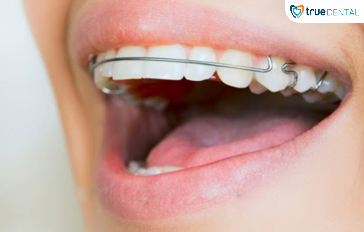 VÌ SAO PHẢI ĐEO HÀM DUY TRÌ SAU KHI CHỈNH NHA? 3 Hàm duy trì tháo lắp kim loại