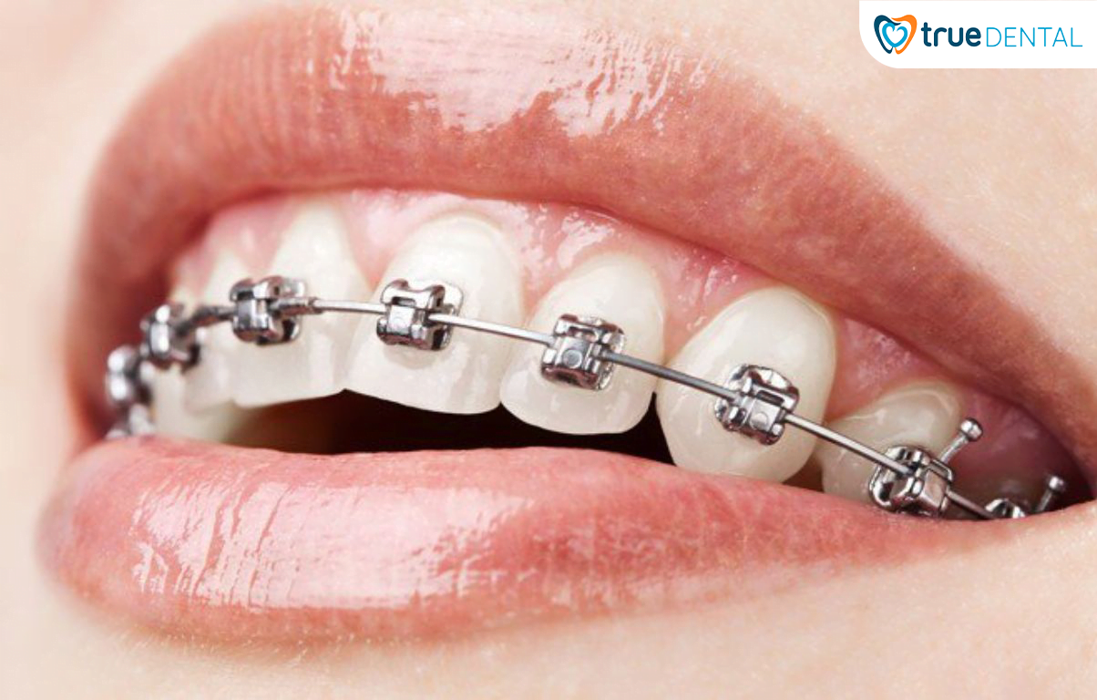 5 CHIA SẺ TỪ BÁC SĨ TRUE DENTAL VỀ NIỀNG RĂNG BẠN NÊN BIẾT 7 Niềng răng mắc cài kim loại khắc phục được hết các tình trạng răng từ đơn giản đến phức tạp