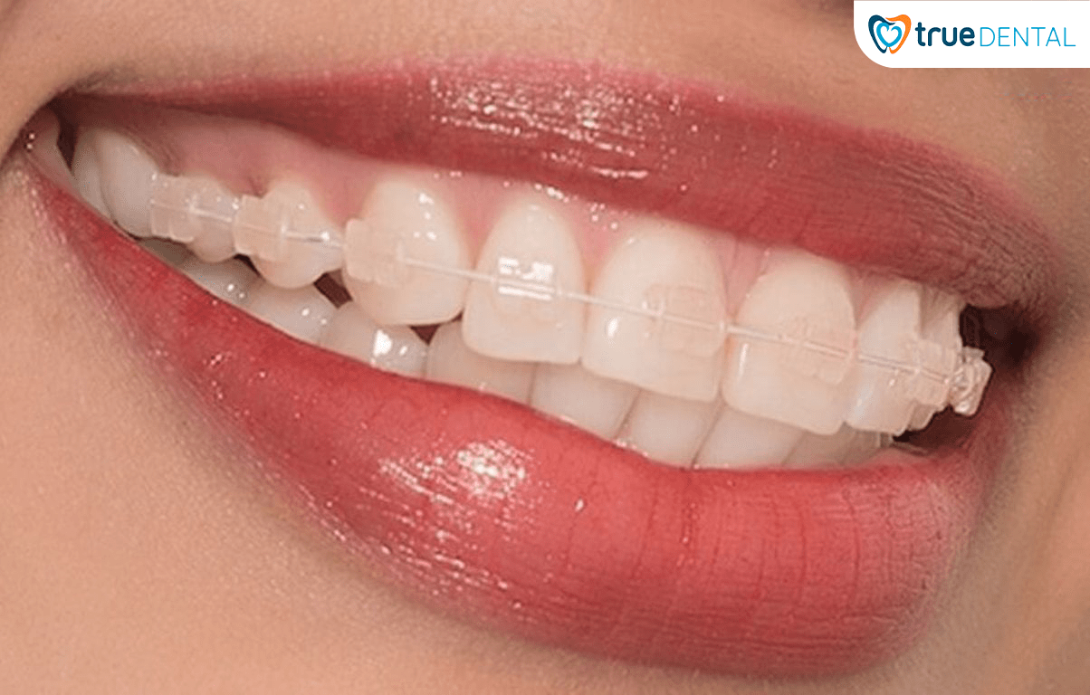 5 CHIA SẺ TỪ BÁC SĨ TRUE DENTAL VỀ NIỀNG RĂNG BẠN NÊN BIẾT 8 Niềng răng mắc cài sứ có màu sắc tương đồng với màu răng đảm bảo tính thẩm mỹ