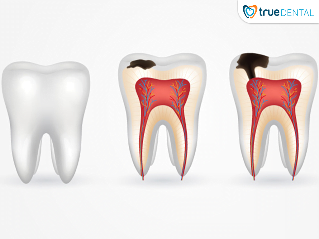 CÁC BỆNH LÝ RĂNG MIỆNG THƯỜNG GẶP: NGUYÊN NHÂN VÀ CÁCH ĐIỀU TRỊ? 1 Sâu răng là 1 trong những bệnh lý răng miệng thường gặp ở mọi lứa tuổi