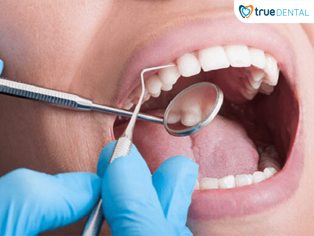 CẠO VÔI RĂNG ĐỊNH KỲ GIÚP NGĂN NGỪA BỆNH LÝ RĂNG MIỆNG HIỆU QUẢ 2 Quy trình cạo vôi răng tại Nha khoa Diva nhanh chóng và an toàn