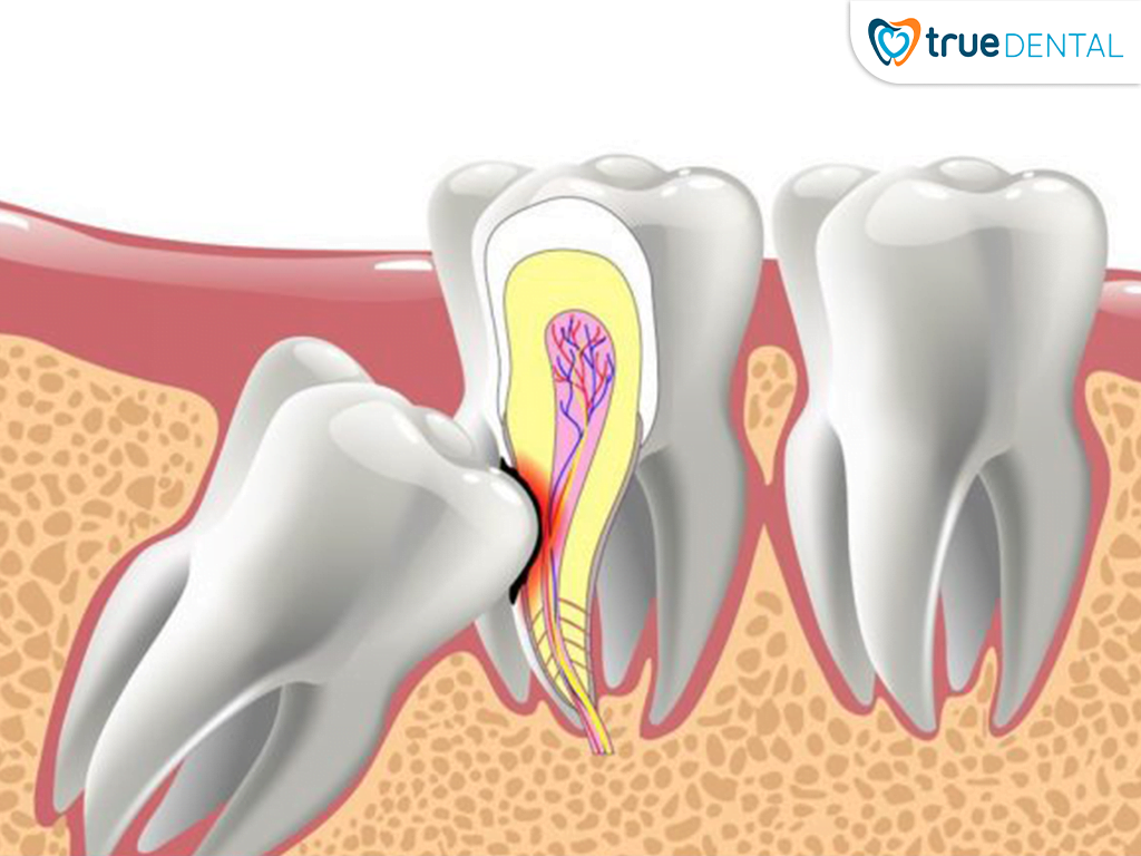NHA KHOA TỔNG QUÁT 2 Răng khôn gây ra nhiều biến chứng nguy hiểm nếu không điều trị kịp thời