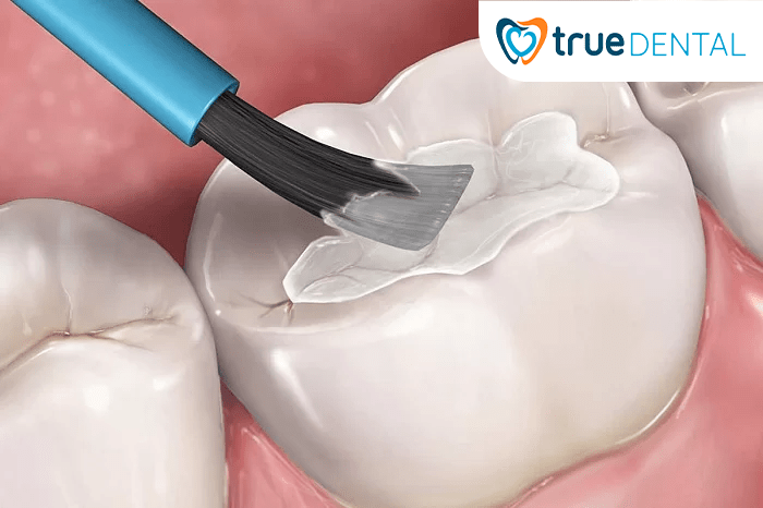 Trám răng là gì? Quy trình trám răng như thế nào 1 Trám răng là kỹ thuật nha khoa dùng vật liệu nhân tạo để phục hồi phần mô răng bị thiếu