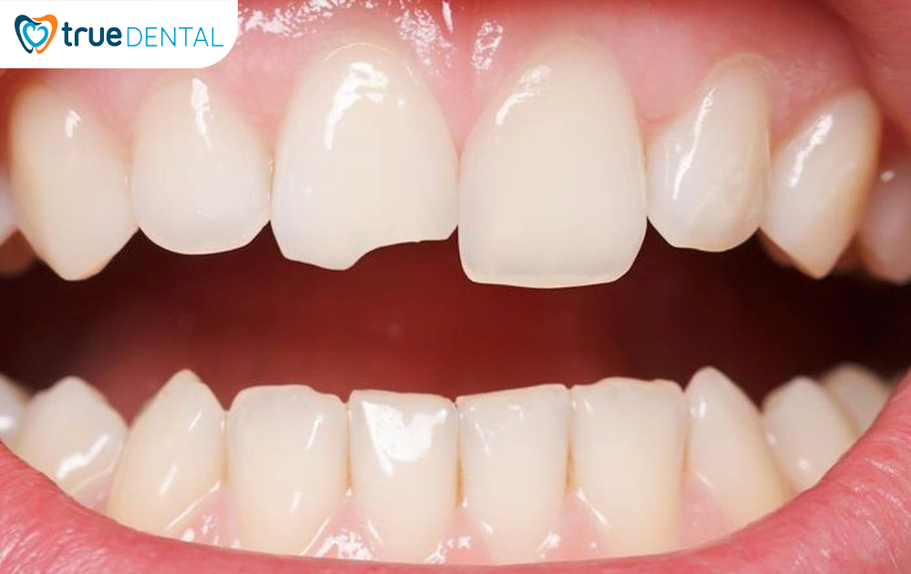 Trám răng là gì? Quy trình trám răng như thế nào 3 Trám răng cũng được thực hiện khi răng bị nứt, mẻ