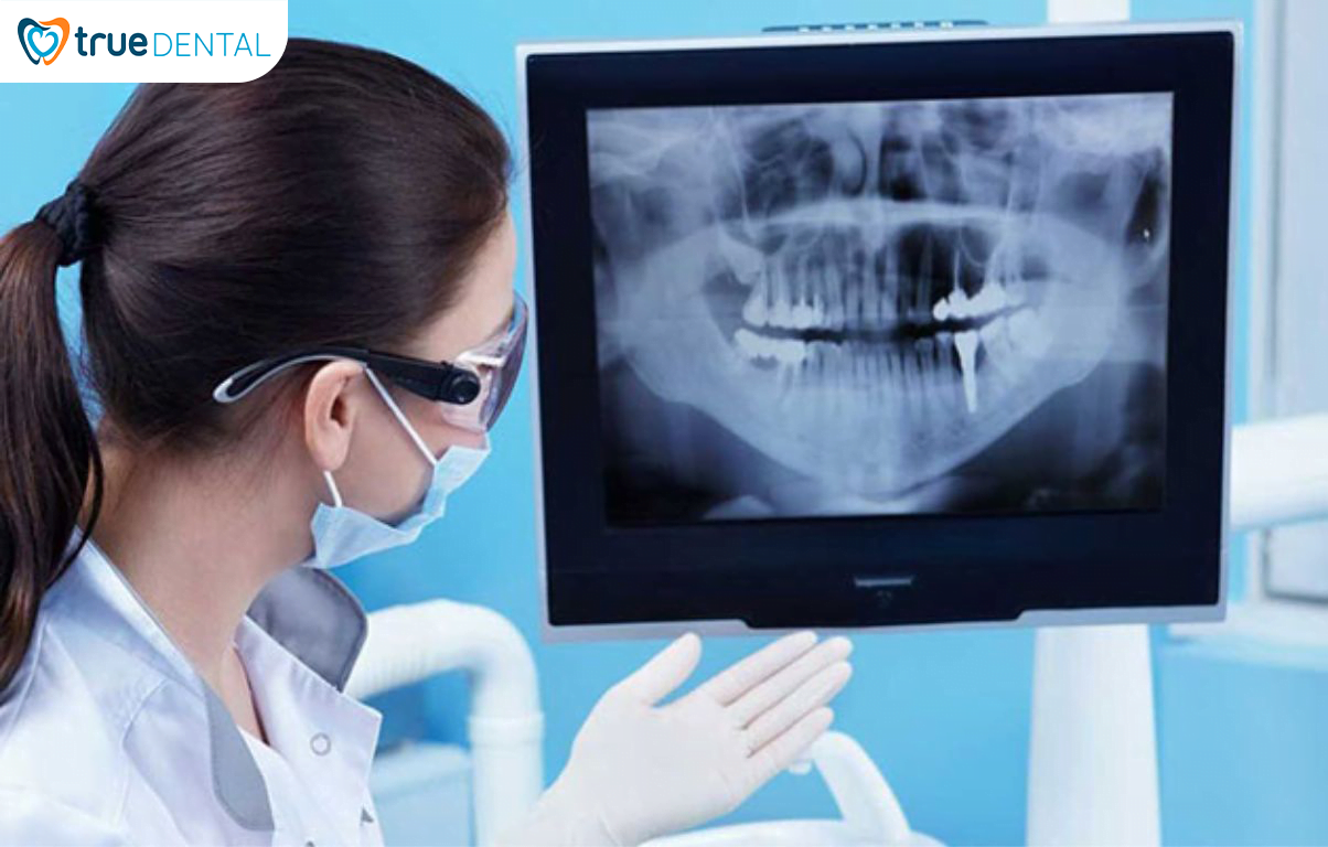 TRỒNG RĂNG IMPLANT - GIẢI PHÁP HOÀN HẢO PHỤC HÌNH RĂNG ĐÃ MẤT 7 Quy trình trồng răng Implant tại True Dental