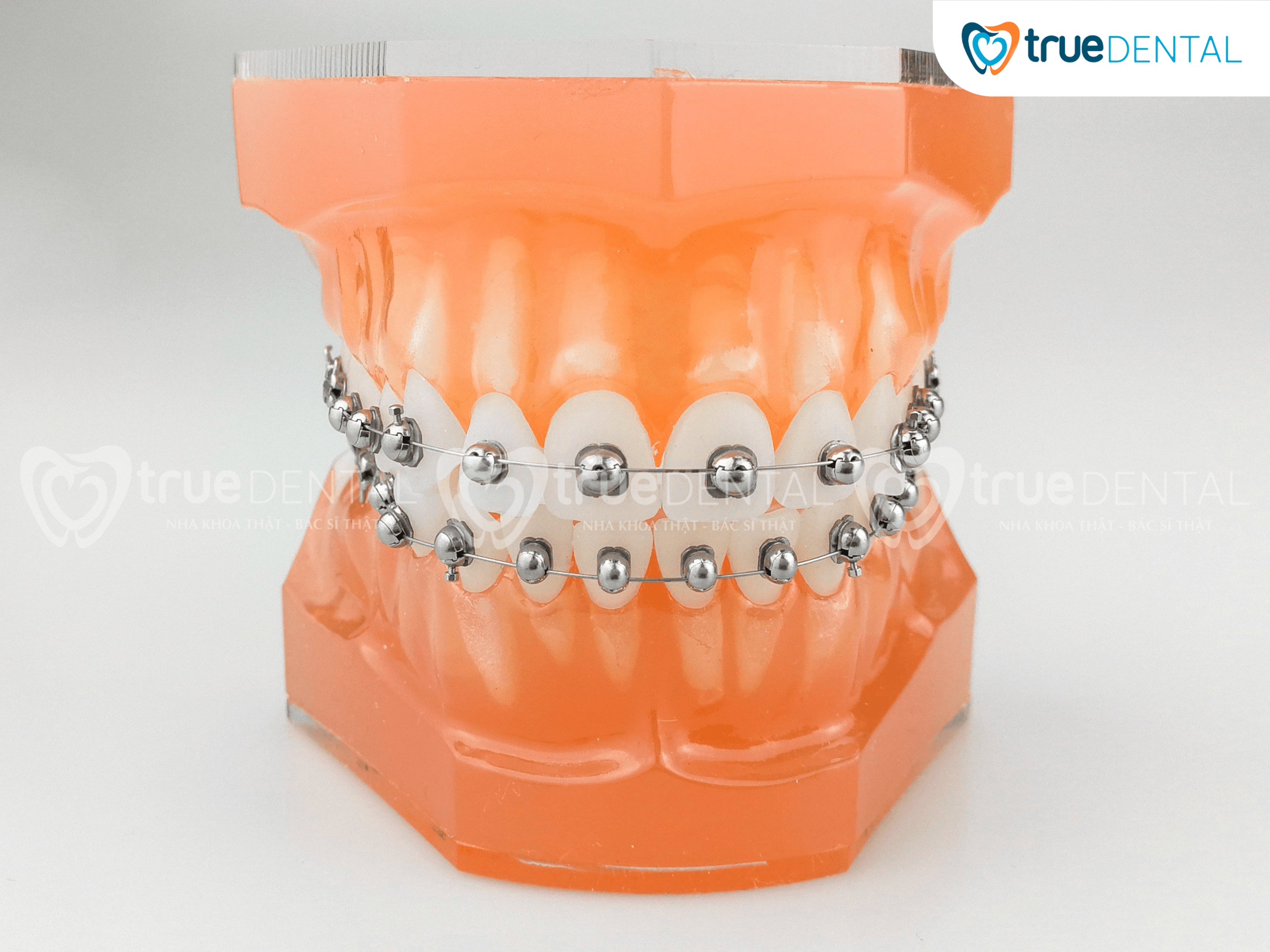 Mắc cài cánh cam giả mạo tràn lan và 4 tiêu chí phân biệt 1 Mắc Cài Cánh Cam là phương pháp niềng răng hiện đại, độc quyền tại True Dental