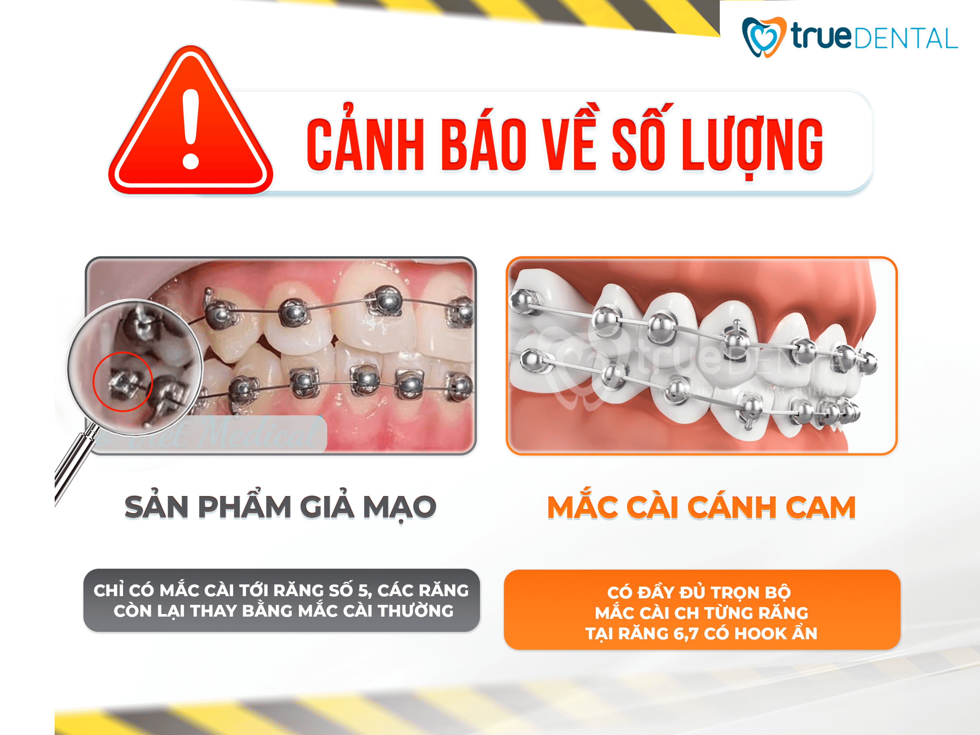 Mắc cài cánh cam giả mạo tràn lan và 4 tiêu chí phân biệt 5 Mắc Cài Cánh Cam giả chỉ có mắc cài tròn đến răng số 5, răng 6 và 7 thay bằng mắc cài thường