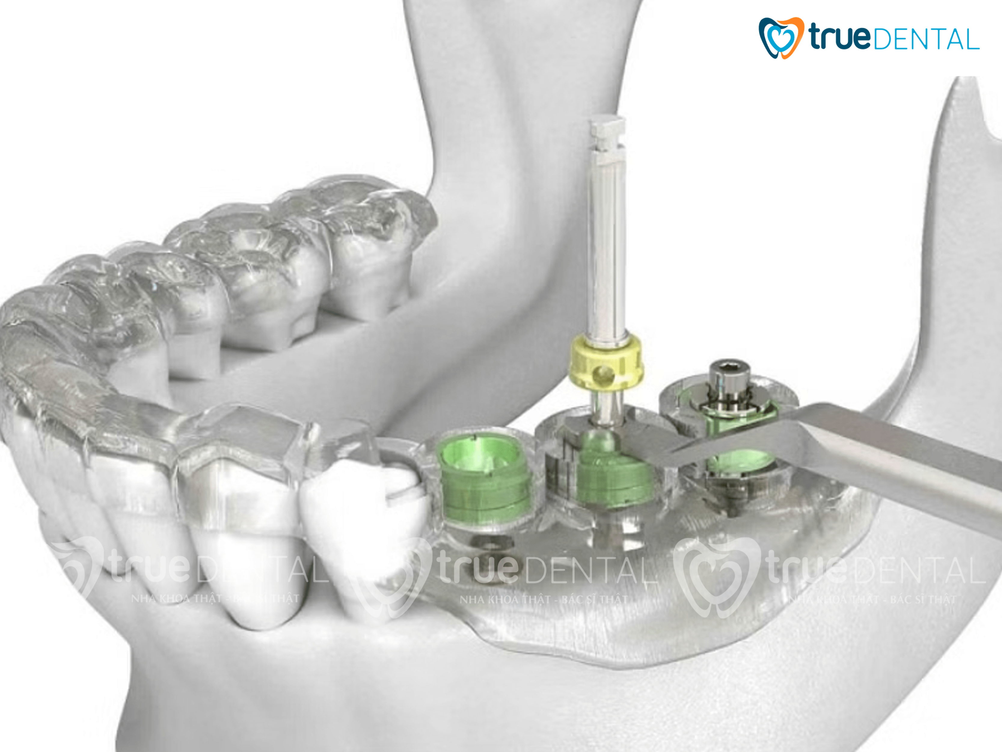 True Dental ứng dụng công nghệ trồng răng Implant GST hiện đại nhất hiện nay