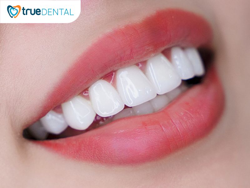 Dáng răng sứ celeb được nhiều người nổi tiếng lựa chọn