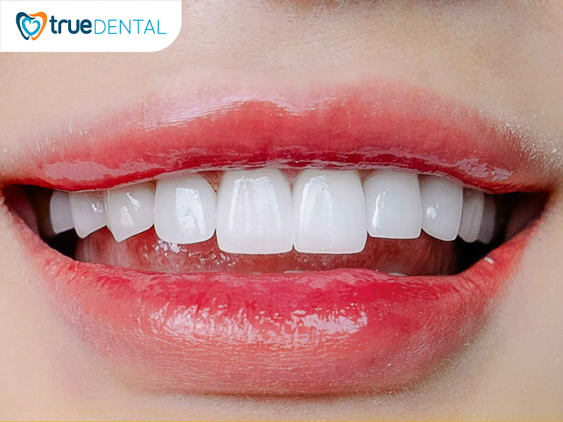 Dáng răng thỏ mang nét đẹp cá tính, được nhiều bạn trẻ ưa chuộng