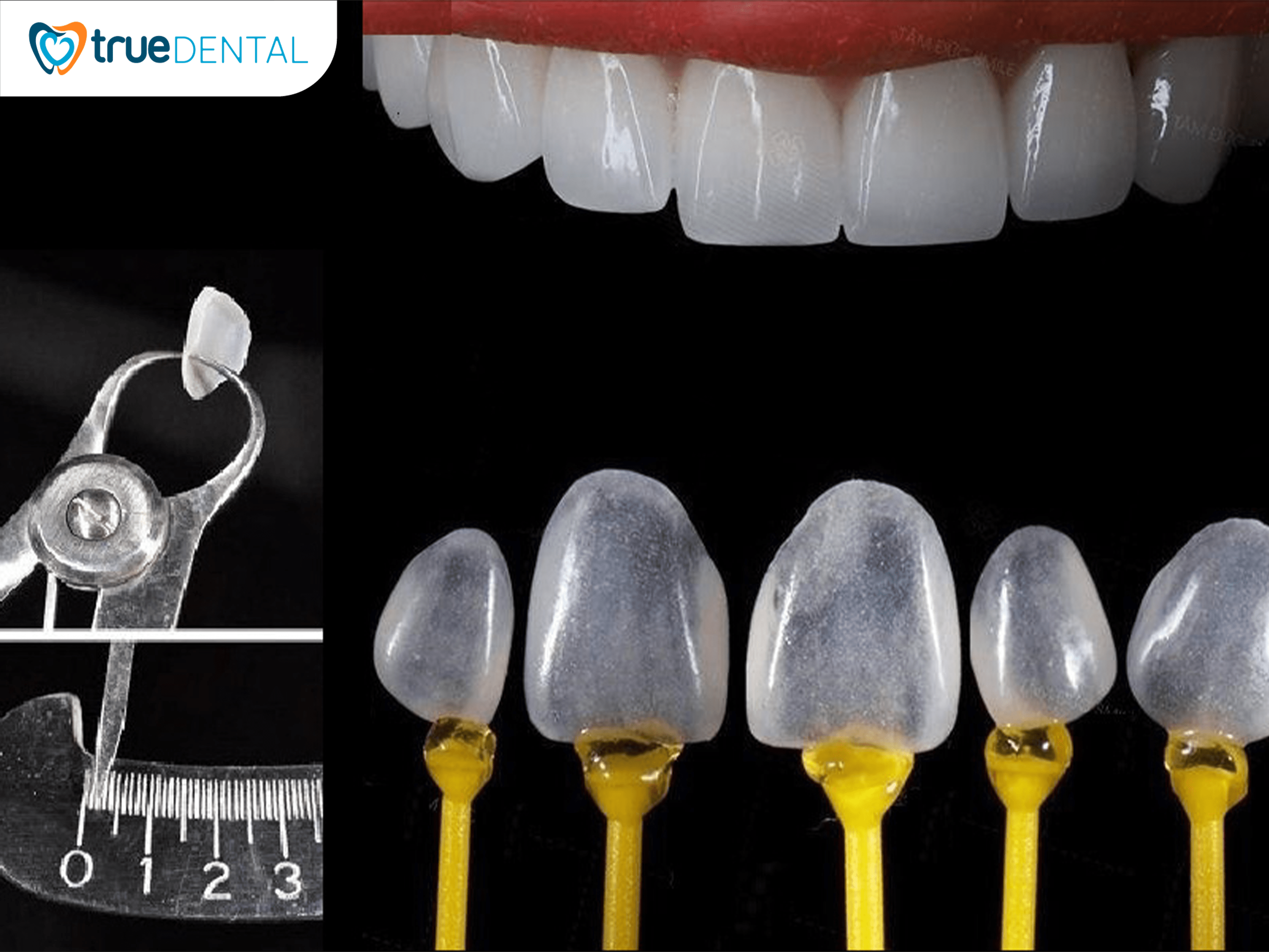 Thẩm Mỹ Răng Sứ Veneer Ultra Thin