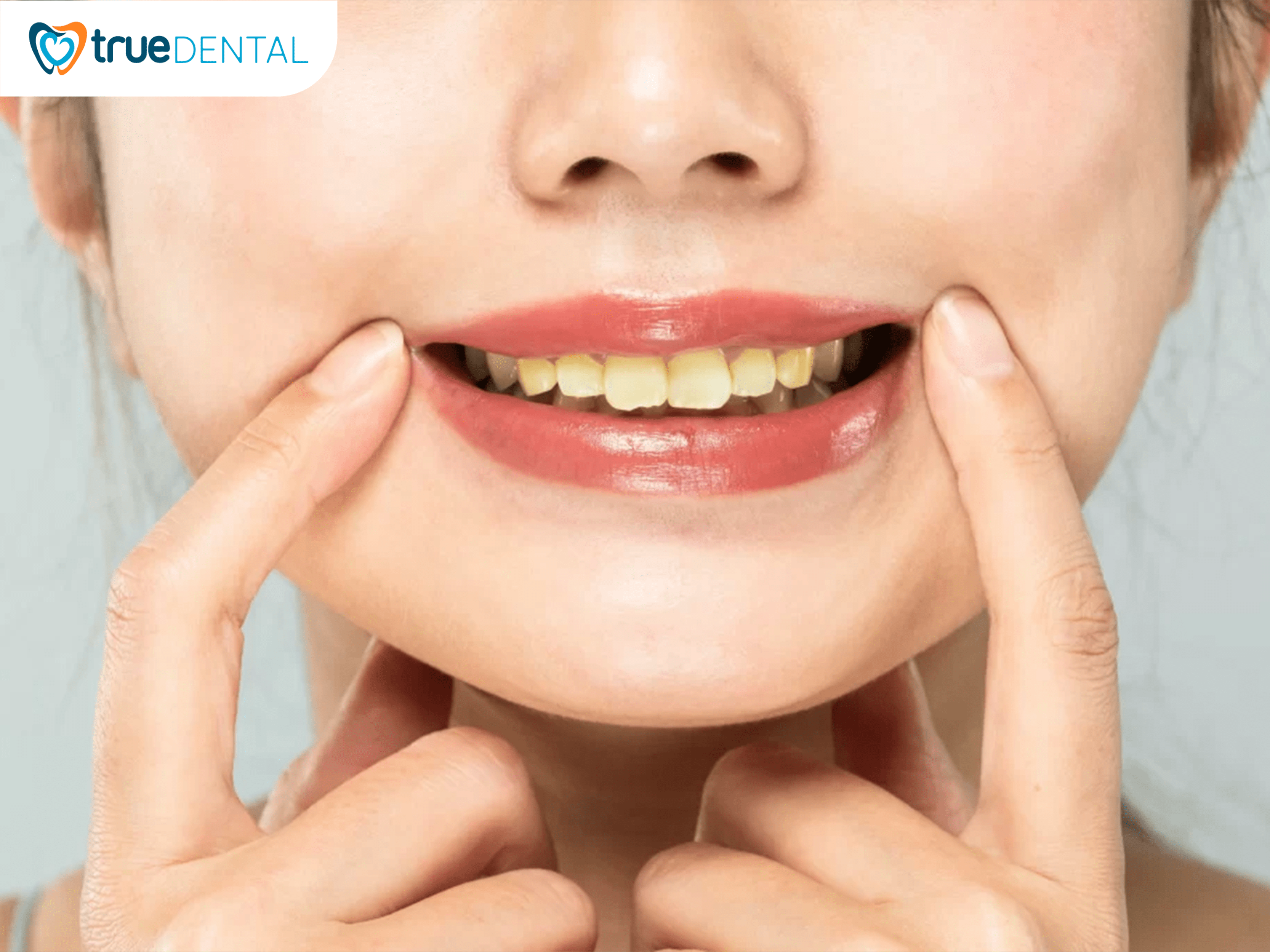 Răng ố vàng: Nguyên nhân và cách khắc phục hiệu quả 1 Răng ố vàng