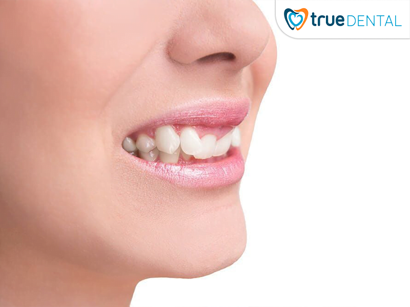 Khớp cắn sâu gây mất thẩm mỹ gương mặt và nụ cười