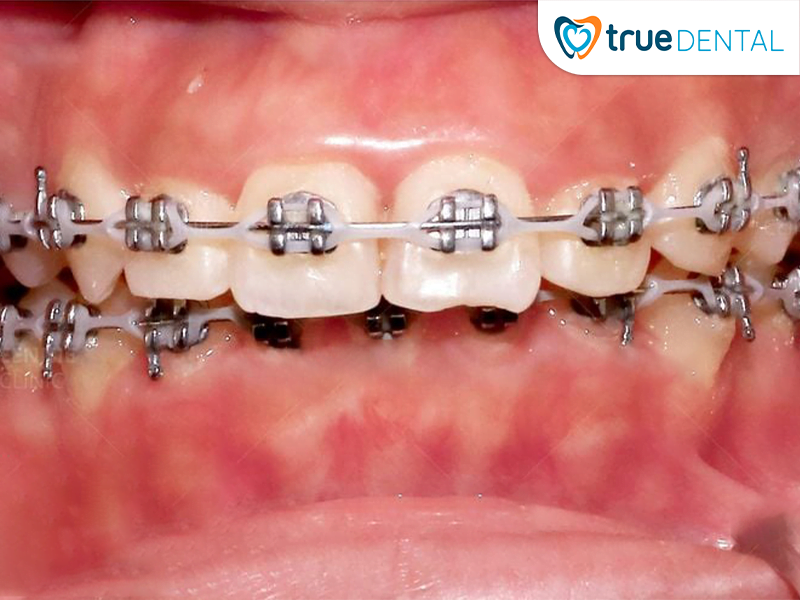 Niềng răng giúp khắc phục khớp cắn sâu do răng hiệu quả