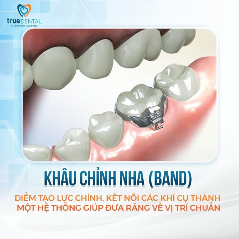 Band niềng răng là gì? Gắn có đau không và công dụng 1 band niềng răng