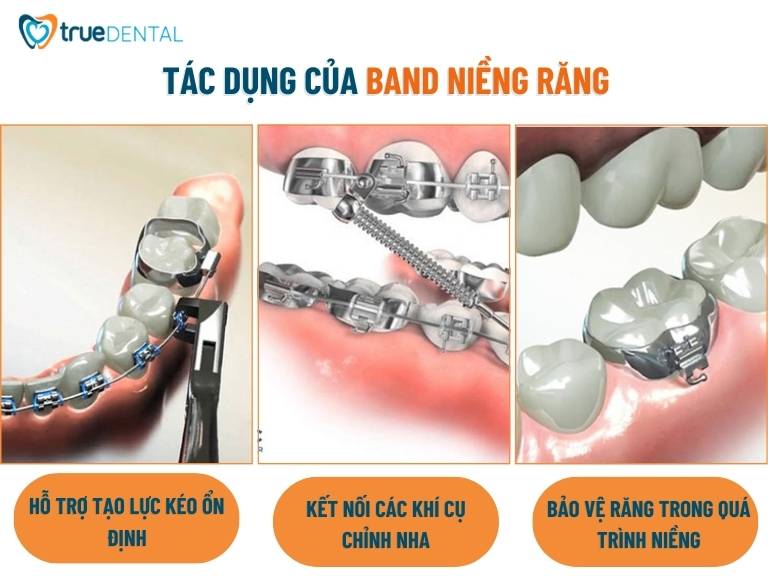 Band niềng răng là gì? Gắn có đau không và công dụng 2 tác dụng của khâu niềng răng