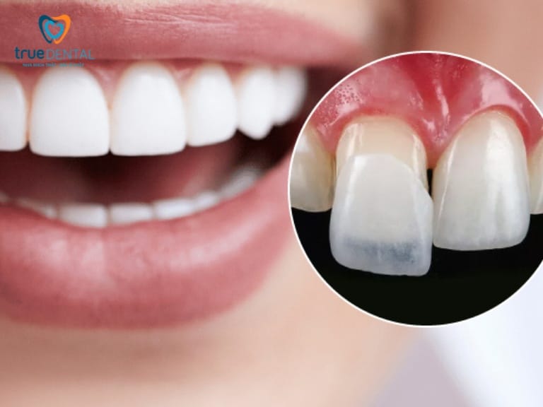 NÊN BỌC RĂNG SỨ HAY THẨM MỸ SỨ VENEER? PHƯƠNG PHÁP NÀO TỐT HƠN? 2 Thẩm mỹ răng sứ Veneer là gì