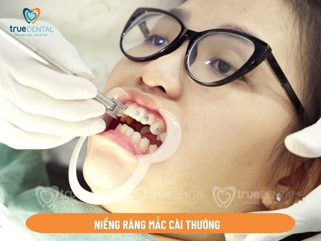 SO SÁNH MẮC CÀI CÁNH CAM VÀ MẮC CÀI THƯỜNG: THẨM MỸ, CHẤT LƯỢNG, GIÁ CẢ 2 niềng răng mắc cài thường