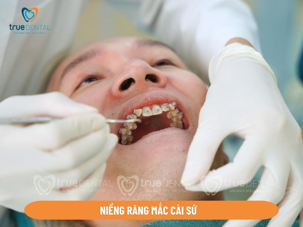 Các loại mắc cài niềng răng đang có mặt trên thị trường 5 loại niềng răng mắc cài sứ