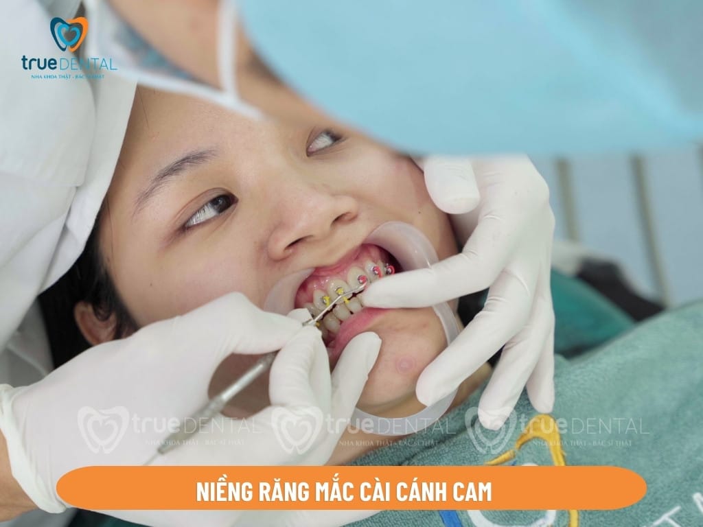 Các loại mắc cài niềng răng đang có mặt trên thị trường 2 loại niềng răng mắc cài cánh cam