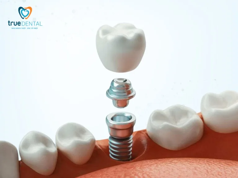 CẤU TẠO CỦA RĂNG IMPLANT VÀ NHỮNG ĐIỀU BẠN CẦN BIẾT 4 mão răng sứ