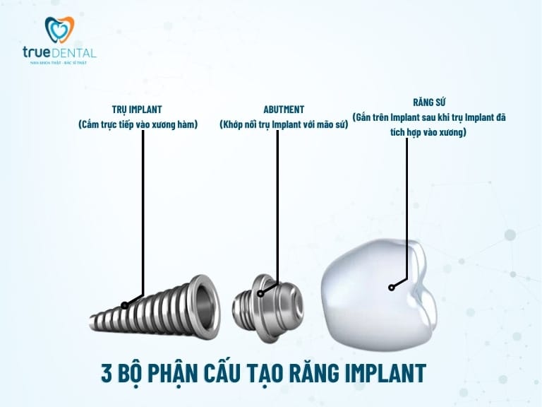CẤU TẠO CỦA RĂNG IMPLANT VÀ NHỮNG ĐIỀU BẠN CẦN BIẾT 1 cấu tạo của răng implant