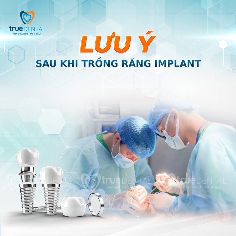CHĂM SÓC RĂNG SAU KHI CẮM IMPLANT NHƯ THẾ NÀO LÀ ĐÚNG CÁCH 3 lưu ý sau khi trồng răng implant