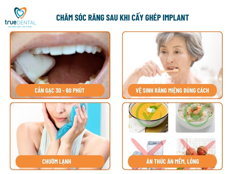 CHĂM SÓC RĂNG SAU KHI CẮM IMPLANT NHƯ THẾ NÀO LÀ ĐÚNG CÁCH 1 chăm sóc răng sau khi cắm implant