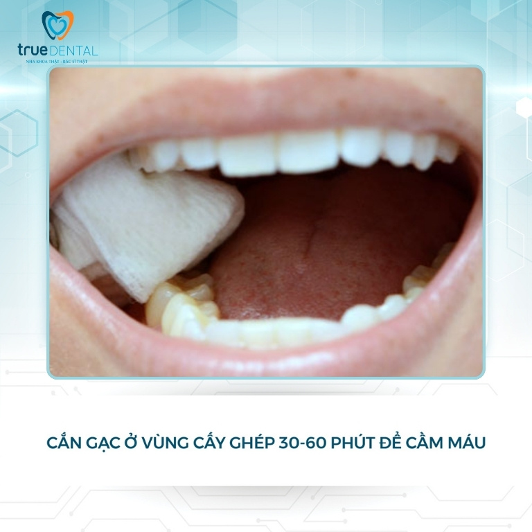 CHĂM SÓC RĂNG SAU KHI CẮM IMPLANT NHƯ THẾ NÀO LÀ ĐÚNG CÁCH 2 chăm sóc răng sau khi ghép xương để cắm implant