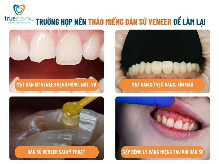 trường hợp có thể tháo miếng dán sứ để gắn lại