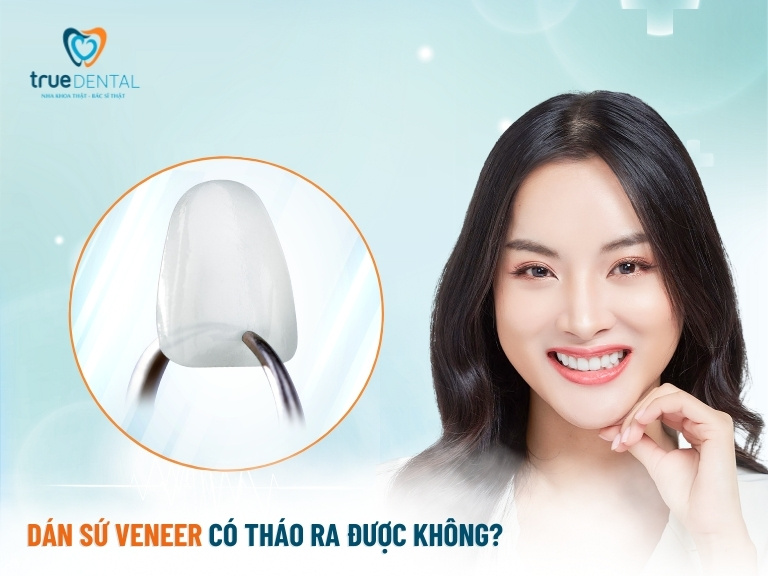 dán sứ veneer có tháo được không 