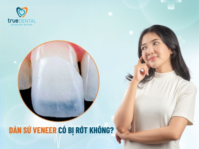 dán sứ Veneer có bị rớt không