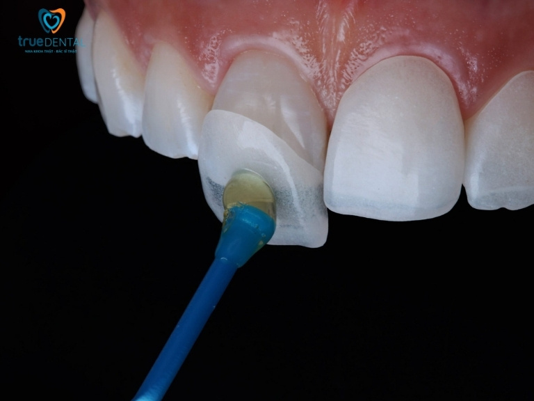 DÁN SỨ VENEER SAI KỸ THUẬT NGUY HIỂM RA SAO? 5 TÁC HẠI CẦN BIẾT 1 Dán sứ Veneer sai kỹ thuật là gì