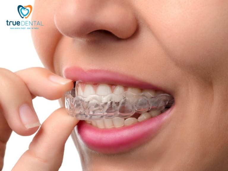 SAU KHI THÁO NIỀNG PHẢI ĐEO HÀM DUY TRÌ BAO LÂU? KHÔNG ĐEO CÓ SAO KHÔNG? 4 yếu tố ảnh hưởng đến thời gian đeo hàm duy trì