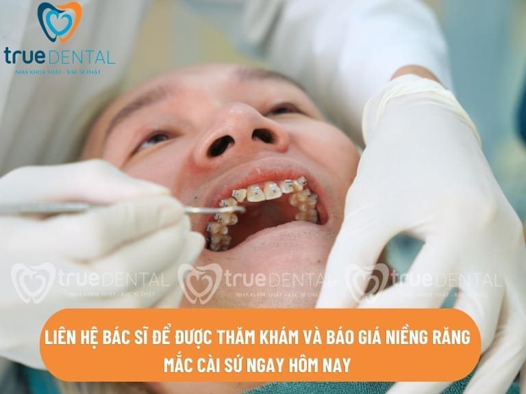 NIỀNG RĂNG MẮC CÀI SỨ THẨM MỸ VÀ NHỮNG ĐIỀU CẦN BIẾT 3 giá niềng răng mắc cài sứ