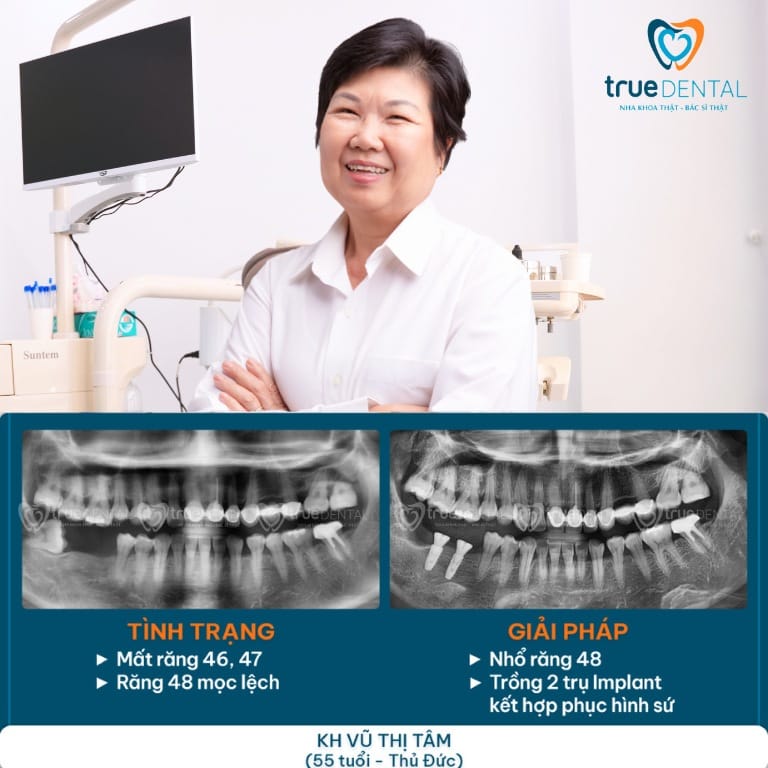 HIỆN TƯỢNG TIÊU XƯƠNG HÀM RĂNG: NGUYÊN NHÂN, DẤU HIỆU VÀ CÁCH ĐIỀU TRỊ 4 Cấy ghép Implant điều trị tiêu xương hàm