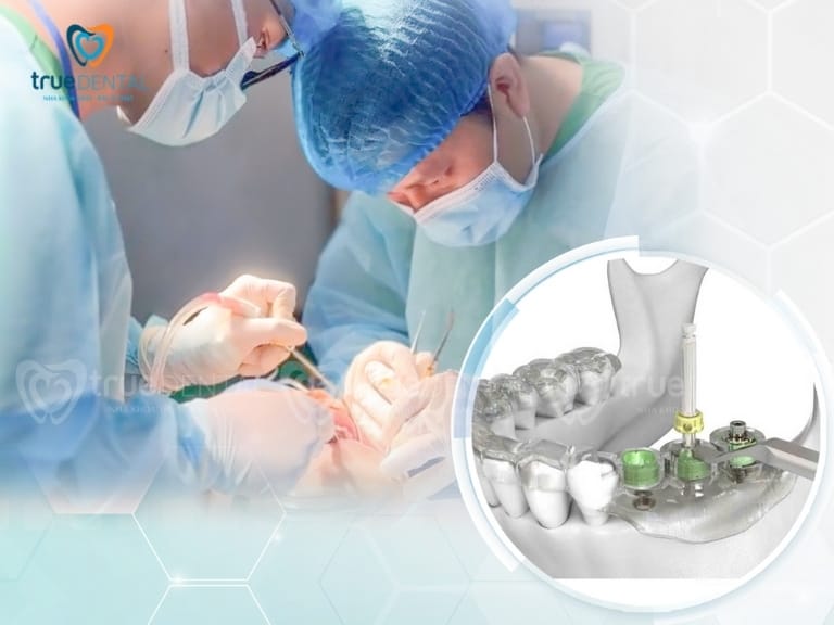 CẤY GHÉP IMPLANT CÔNG NGHỆ GST VÀ IMPLANT TRUYỀN THỐNG: NÊN CHỌN LOẠI NÀO? 2 cấy ghép implant công nghệ gst và trồng răng implant truyền thống