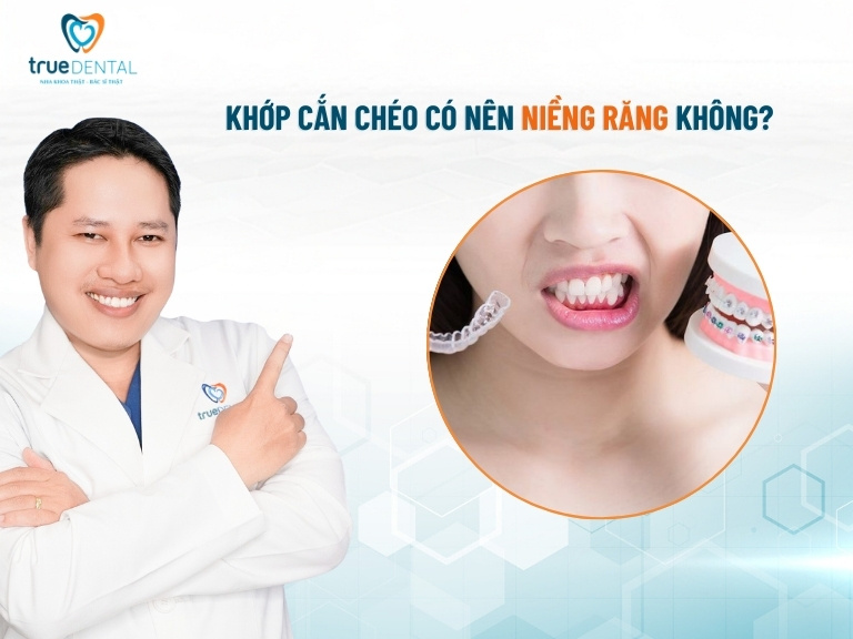 BỊ KHỚP CẮN CHÉO CÓ NÊN NIỀNG RĂNG KHÔNG? CÓ NHỮNG PHƯƠNG PHÁP NÀO? 2 Khớp cắn chéo có nên niềng răng không