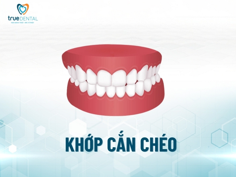 BỊ KHỚP CẮN CHÉO CÓ NÊN NIỀNG RĂNG KHÔNG? CÓ NHỮNG PHƯƠNG PHÁP NÀO? 1 Khớp cắn chéo là gì