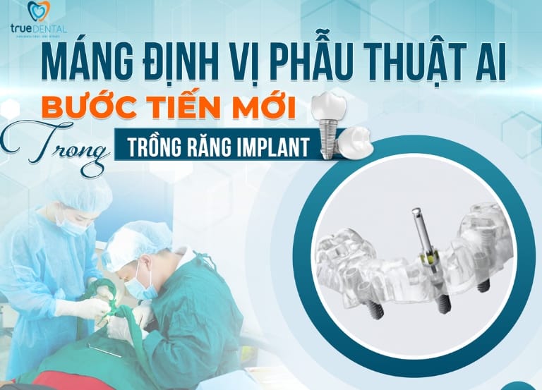 MÁNG ĐỊNH VỊ PHẪU THUẬT AI - BƯỚC TIẾN MỚI TRONG TRỒNG RĂNG IMPLANT 4 quy trình cấy ghép implant có sử dụng máng định vị phẫu thuật AI