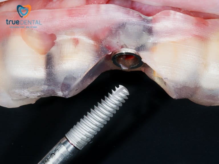 MÁNG ĐỊNH VỊ PHẪU THUẬT AI - BƯỚC TIẾN MỚI TRONG TRỒNG RĂNG IMPLANT 1 máng hướng dẫn phẫu thuật - công nghệ mới trong trồng răng implant
