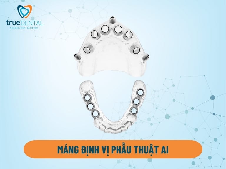 MÁNG ĐỊNH VỊ PHẪU THUẬT AI - BƯỚC TIẾN MỚI TRONG TRỒNG RĂNG IMPLANT 2 máng định vị phẫu thuật AI