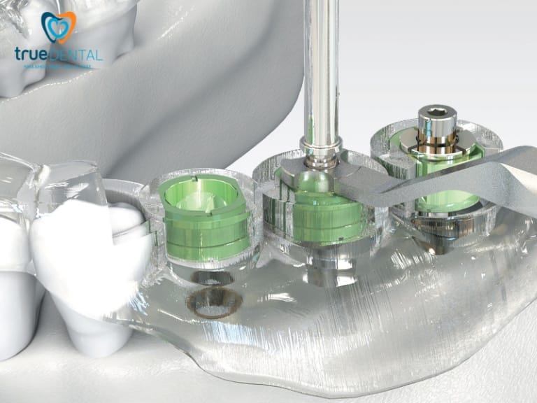 MÁNG ĐỊNH VỊ PHẪU THUẬT AI - BƯỚC TIẾN MỚI TRONG TRỒNG RĂNG IMPLANT 3 cấu tạo máng định vị phẫu thuật AI
