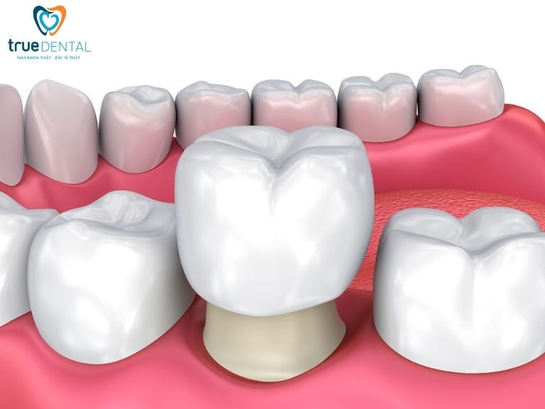 NÊN BỌC RĂNG SỨ HAY THẨM MỸ SỨ VENEER? PHƯƠNG PHÁP NÀO TỐT HƠN? 1 boc rang su la gi